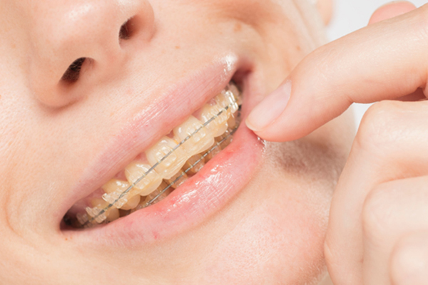 Things You May Not Have Known About Clear Braces